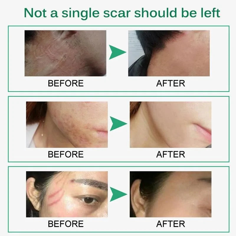 Scar Removal Cream - Addy Mart